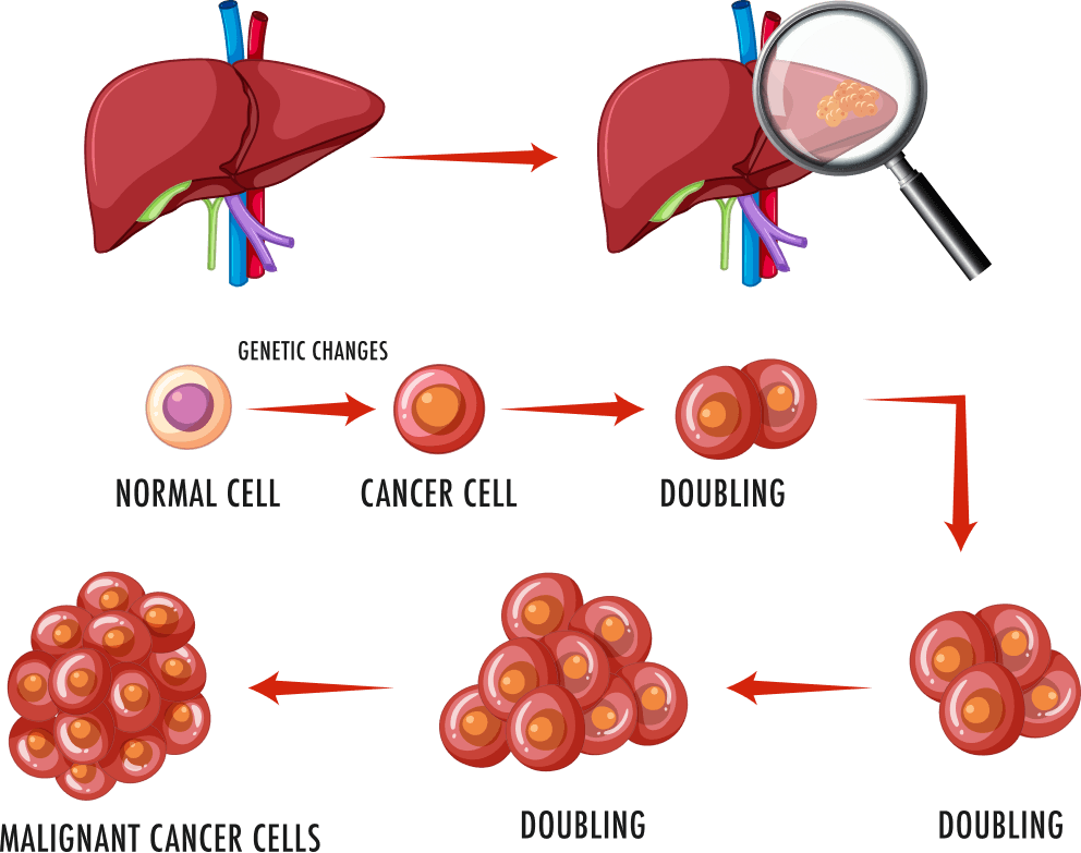 Liver transplant overview diagram